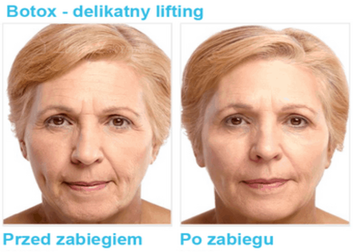Botox Pszczyna