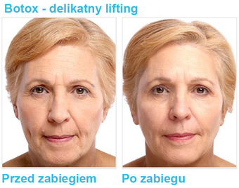 Botox Pszczyna